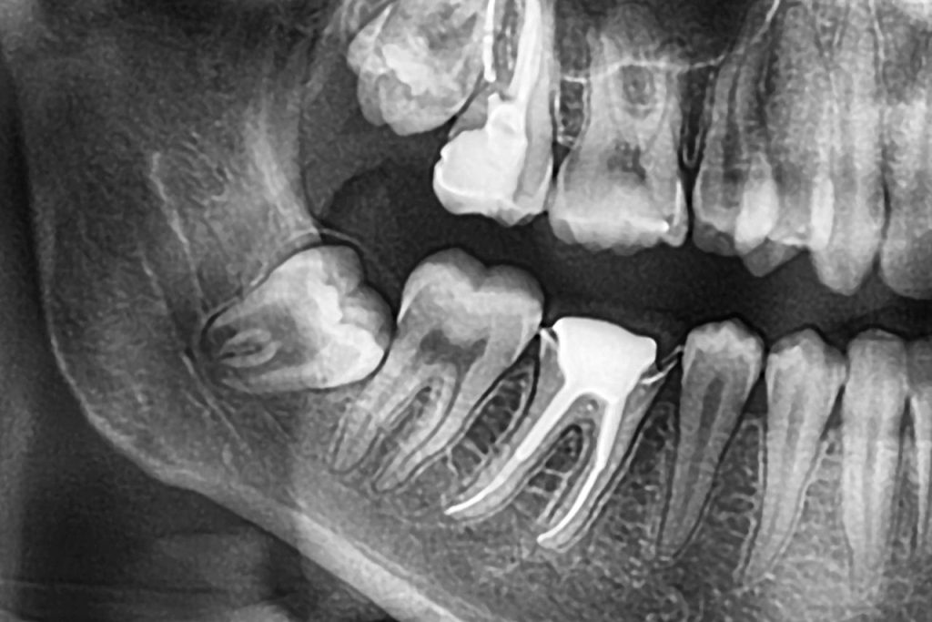 traitement de canal - Centre de santé dentaire des Haut-Bois